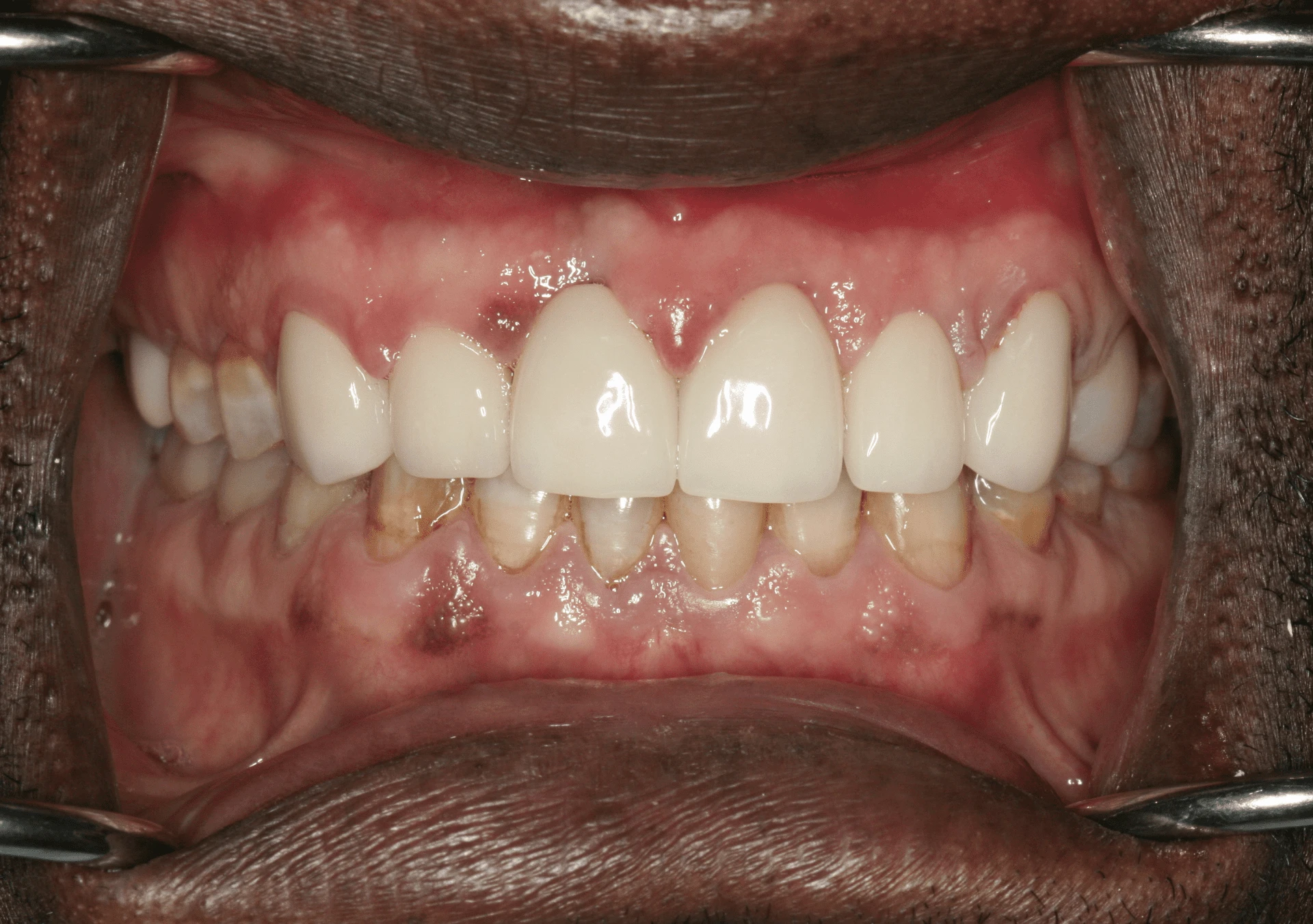 Oral Rehabilitation Case 1