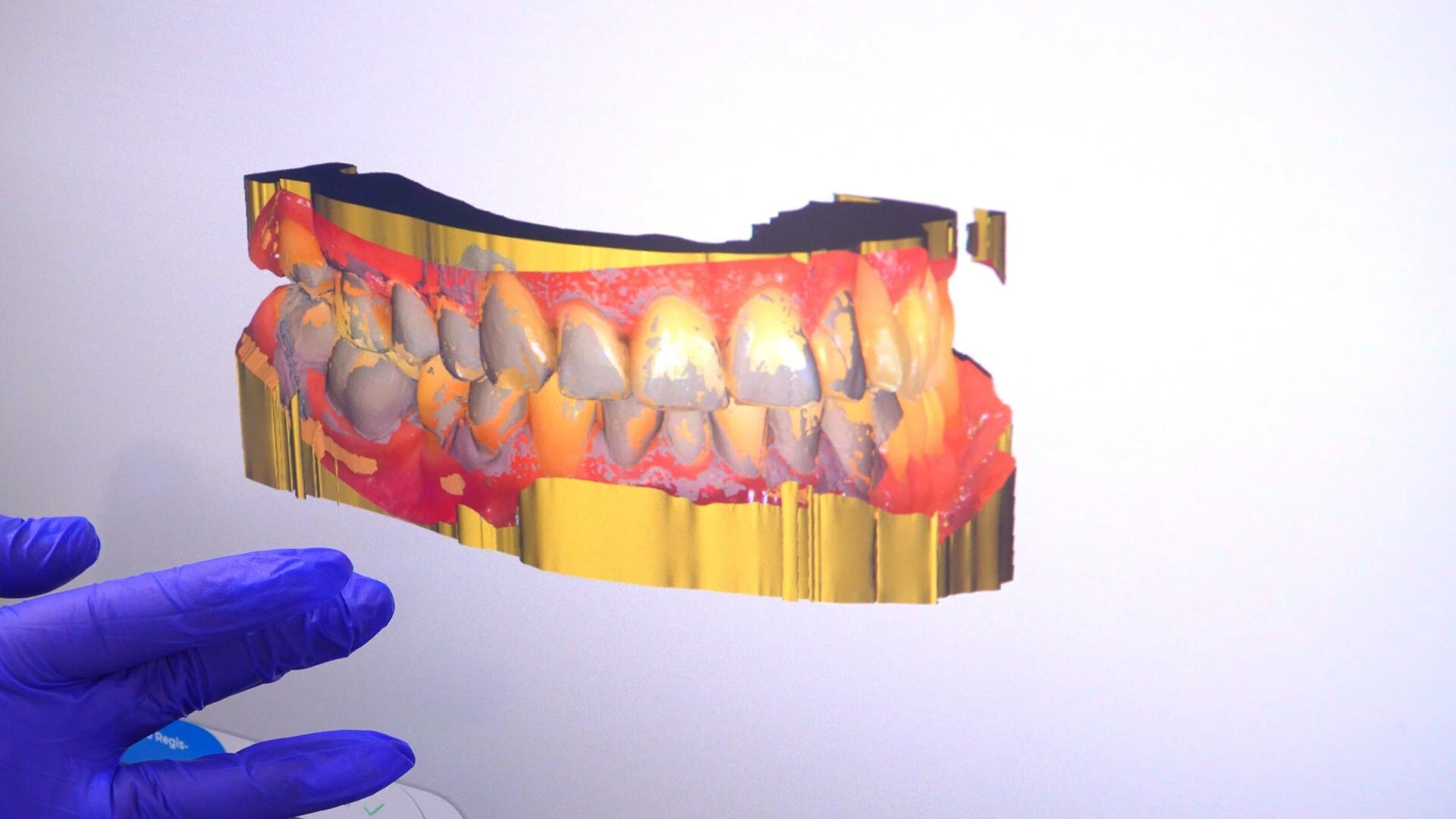 A detailed 3D digital model of human teeth and gums on a computer screen, representing an intraoral dental scan used for diagnostics and treatment planning.