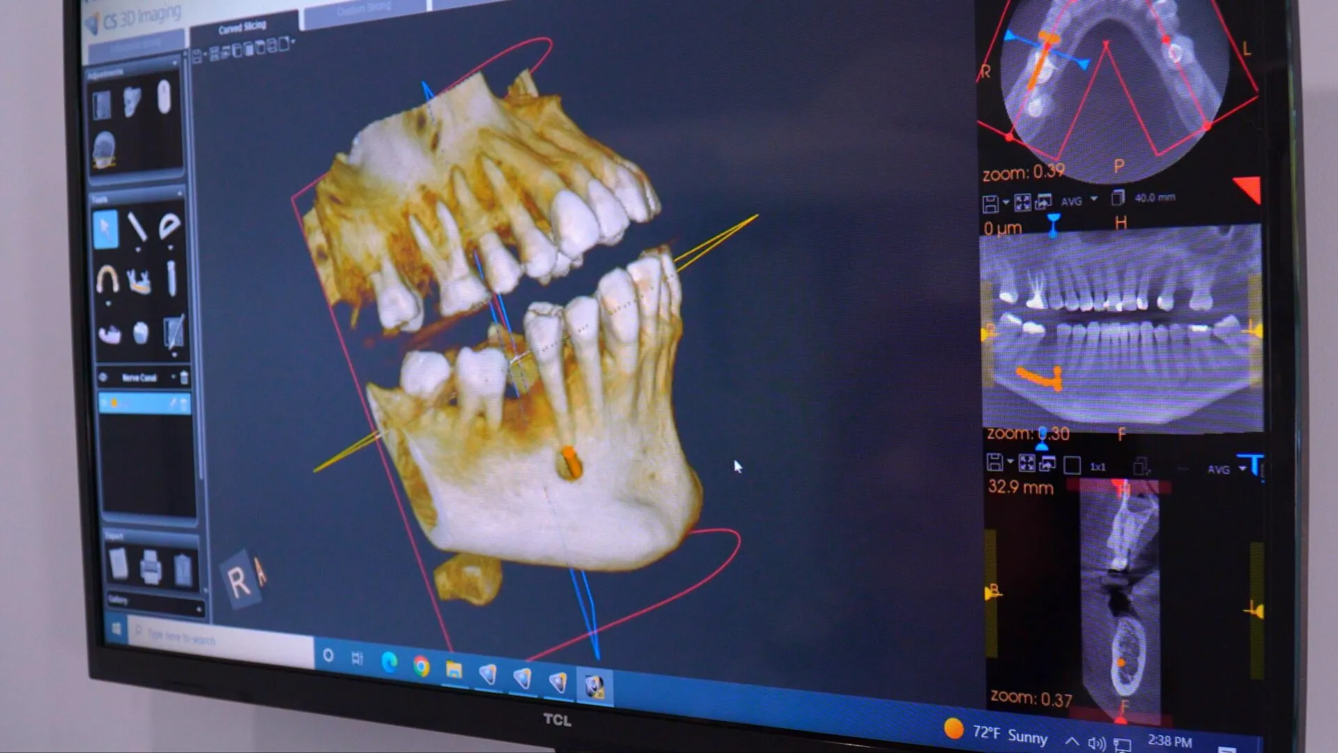 A high-resolution 3D dental scan of a human jaw displayed on a CS 3D Imaging software monitor for orthodontic planning.