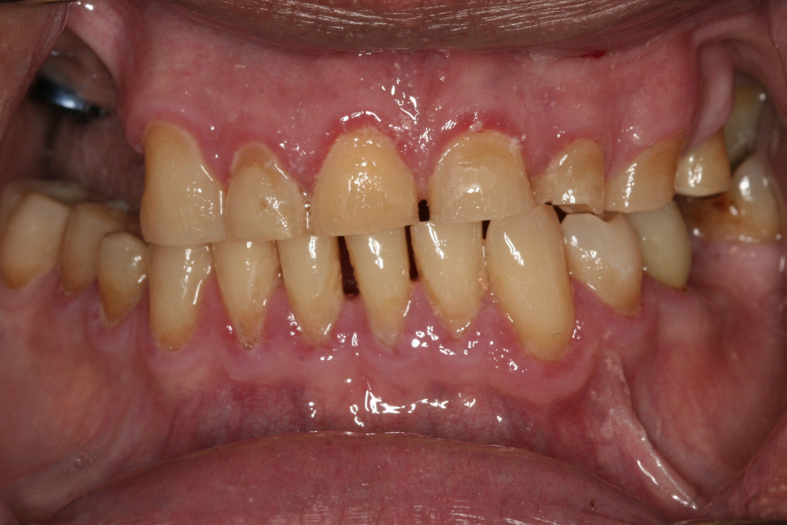 Oral Rehabilitation Case 3