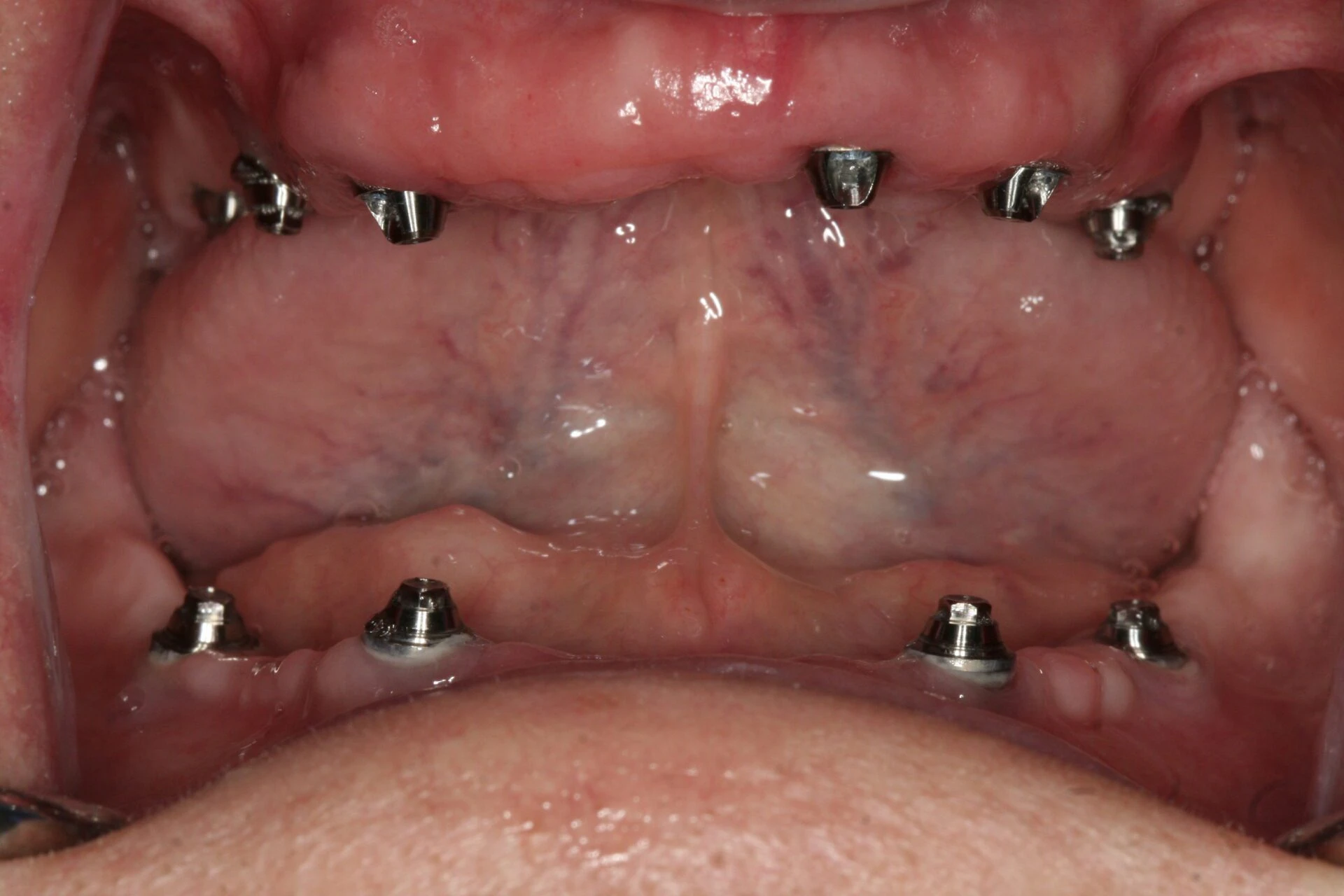 Oral Rehabilitation Case 3