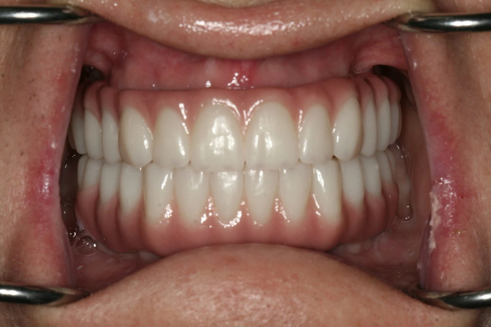 Oral Rehabilitation Case 3