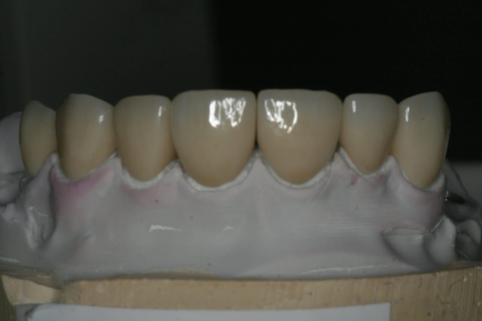 Oral Rehabilitation Case 3
