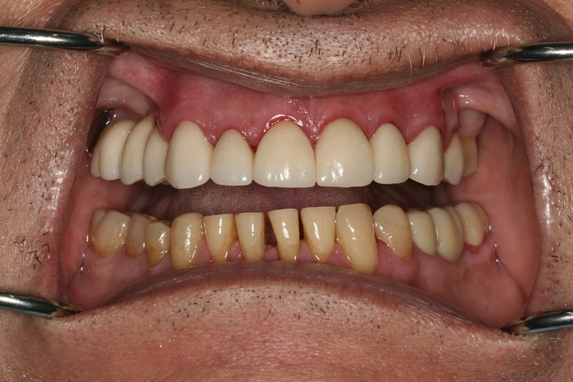 Oral Rehabilitation Case 3